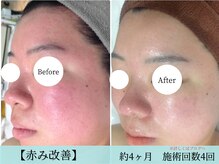 ルノン(LUNON)の雰囲気(赤み改善その他Before/afterはフォトギャラリーをご覧ください。)