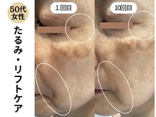 ディレイア ザ コスメ 有楽町マルイ店(direia the cosme)/たるみ/リフト/しわ［有楽町］