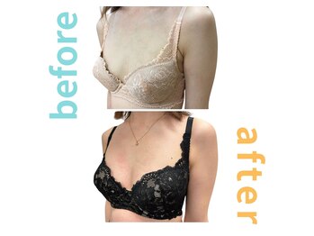 シエル(Ciel)/バストアップ施術３回目→７回目