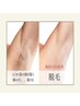 【脱毛】ハイパワー脱毛☆抜け感が別格お試し4か所セレクト脱毛 初回¥6600