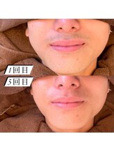 ルーチェ/【ヒゲ脱毛】2週間に1回/5回照射