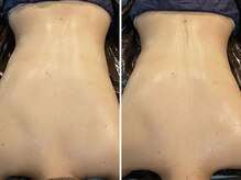 カプリス(CAPRiCE)/リンパドレナージュ