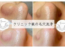 エヌ ドット ジュウイチ(N.11)/長年の黒ずみ毛穴これで解決！