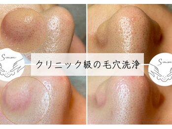 エヌ ドット ジュウイチ(N.11)/長年の黒ずみ毛穴これで解決！