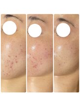 エムリシェ(M.riche)/ハーブピーリング