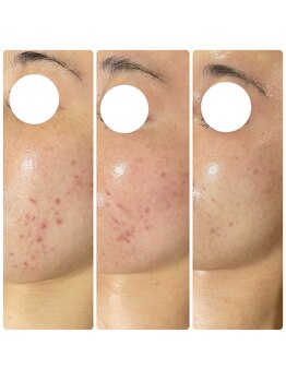 エムリシェ(M.riche)/ハーブピーリング