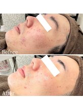 エステ ニキビケア研究所 川崎店/毛穴から変わる！ハリツヤ肌へ！