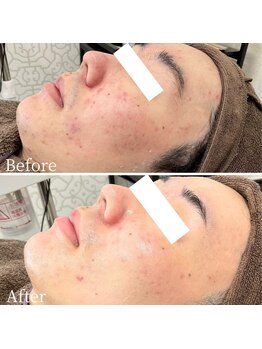 エステ ニキビケア研究所 川崎店/毛穴から変わる!ハリツヤ肌へ!