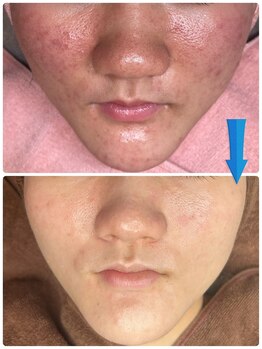 ジョンミー(JONMEE)/ハーブピーリングでニキビケア