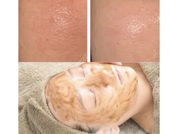 メディカルエース(MedicalAce)の写真/お肌に優しく効果も高い！【レスキューケア】たるみ改善、鎮静が叶うセットメニューが人気♪マタニティもOK