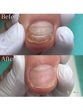 巻き爪補正店 越谷店/変形爪補正