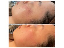 レアナチュラルケアサロン(Lea natural care salon)の雰囲気(静岡のシミケアサロン★シミとり放題が人気○シミケア・毛穴)