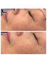 アイラッシュ ミル 御領店(eye lash Miru)/エイジングケア