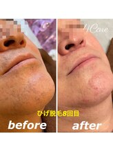 フォーケア(4Care)/メンズひげ脱毛