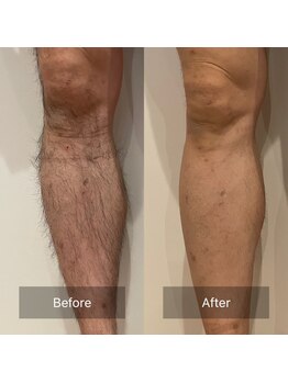 ルーチェ/【脱毛箇所】脚