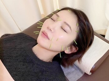 アリス鍼灸整骨院の写真/【美容鍼¥3500】リフトアップして小顔に◎むくみ緩和やシミ・シワ改善にもオススメ♪ハリのある素肌へ☆