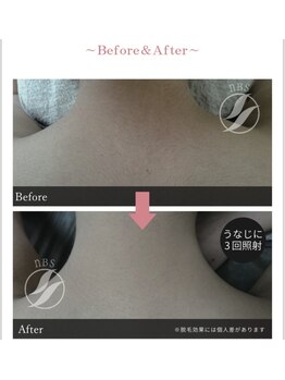 ビュール(VIERU)/レディース部分脱毛【うなじ】