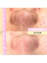 Cスキンケアクリニック 麻布店/毛穴洗浄ハイドラフェイシャル