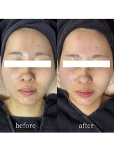 スピカ(Spica)/spicaの小顔コース 3回施術後