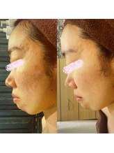 アユアランリンク 札幌店/1ヵ月でなめらか肌に！横向き