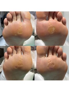 巻き爪補正店 川崎駅前店/タコ・魚の目ケア