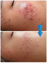 ジョンミー(JONMEE)/ハーブピーリングで毛穴改善！