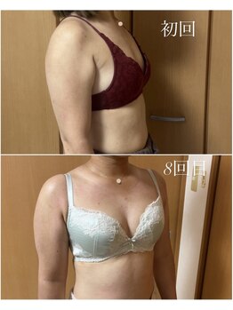 エース(A)/ブラのパカつき解消