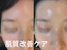 【年齢肌・くすみに】剥離なしハーブピーリング