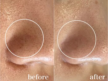 ルアナ(Luana)/【毛穴コース】