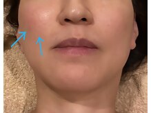 エテルナ(Eterna)の雰囲気（.エンダモロジーFACE1回頬の位置が上がっています。）