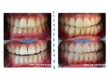ネージュ(neige)の雰囲気（お客様のBefore→After写真☆通う頻度に比例して確実に白くなる）