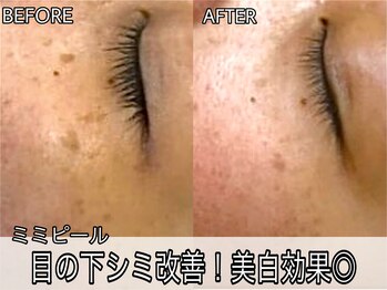 ヴィオール 名古屋栄店(VIOR)/最強美白ピーリング◎ シミ改善