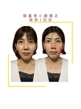 ヴィヴァーチェ(VIVACE)/頭蓋骨小顔矯正ビフォーアフター