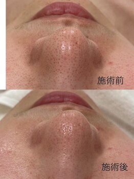 ケンビラク(Kenbiraku 健美楽)/小鼻毛穴洗浄吸引　美容液導入