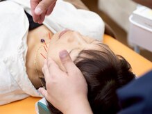 あうる鍼灸接骨院 整体院/【鍼灸エステ】小顔/たるみケア