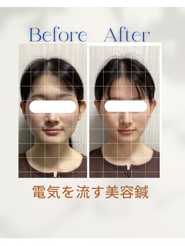 サロン ド ハリッシュ(Salon de HARISH)/電気を流す美容鍼 1回目