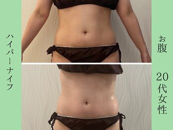 ソルニス(Solnis.)/痩身☆脂肪分解/ハイパーナイフ