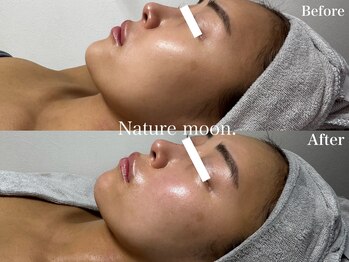 ナチュールムーン(Nature moon.)/ハーブピーリング