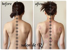 サロン ド アール(salon de R.)/【お背中骨氣・20代・施術効果】