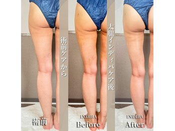 術後の女神 大阪本町店/ダウンタイムケア・インディバ