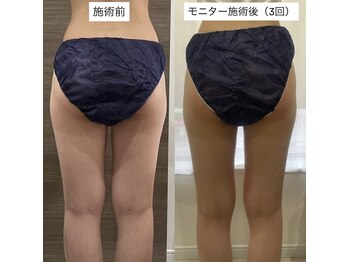 ケーサロン 志木店(K salon)/脂肪冷却モニター4カップ