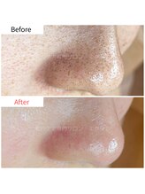 エクシア(Excia)/次世代毛穴洗浄