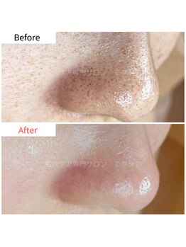 エクシア(Excia)/次世代毛穴洗浄