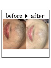 ザ カリビア(The CAREBEA)/ヒゲ脱毛