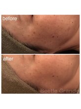 ビューティーモール(BEAUTY MALL)/ハーバルピール(レベル4)1回施術