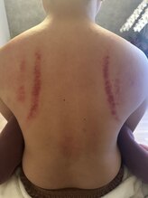 ホスピー(Hosppy)/肩こり解消