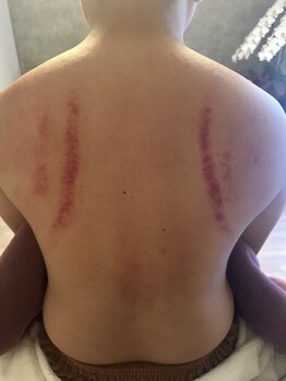 ホスピー(Hosppy)/肩こり解消