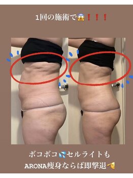 アローナ(ARONA)/一回でしっかり結果出し！