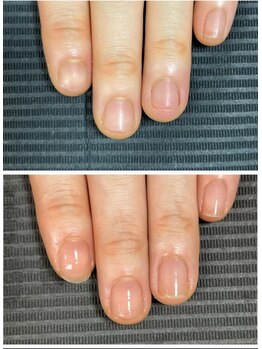 ルカロンネイル(Rukaron Nail)/埋もれてる爪