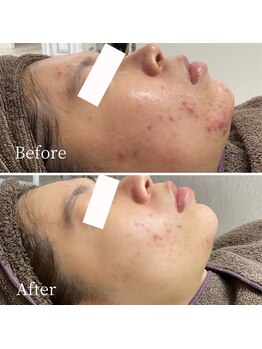 エステ ニキビケア研究所 川崎店/思春期ニキビも大人ニキビもケア